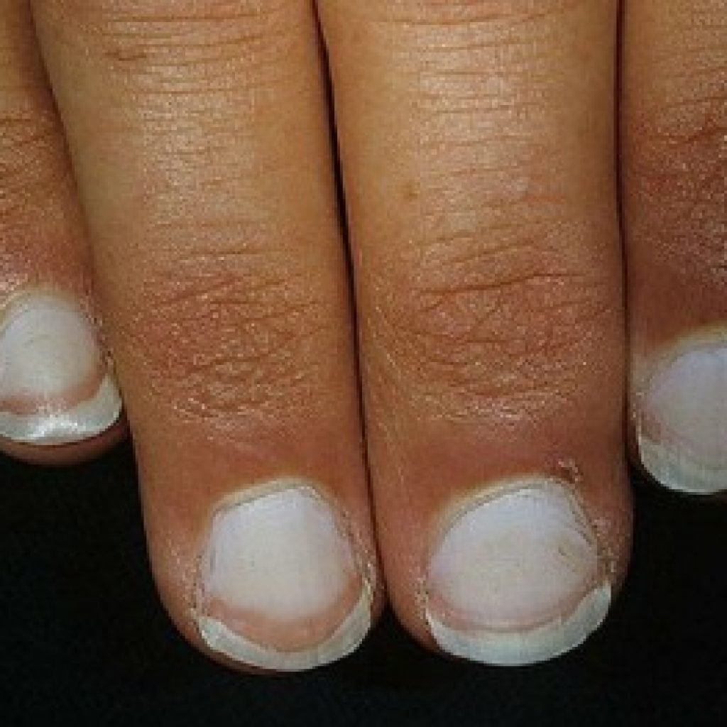 Что означают белые пятна на ногтях рук. Лейконихия тотальная тотальная лейконихия. Ониходистрофия, лейконихия.