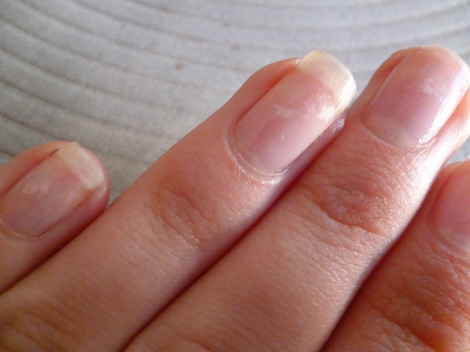 Что означают белые пятна на ногтях рук