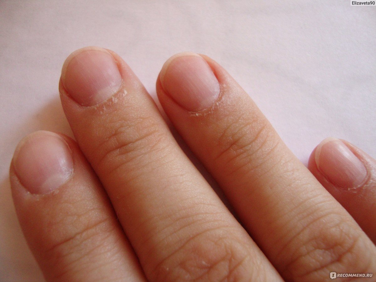 Перепиленные ногти после аппаратного маникюра. Пропилы на ногтях после аппаратного маникюра. Пропилы на ногтях после аппаратного маникюра фото.