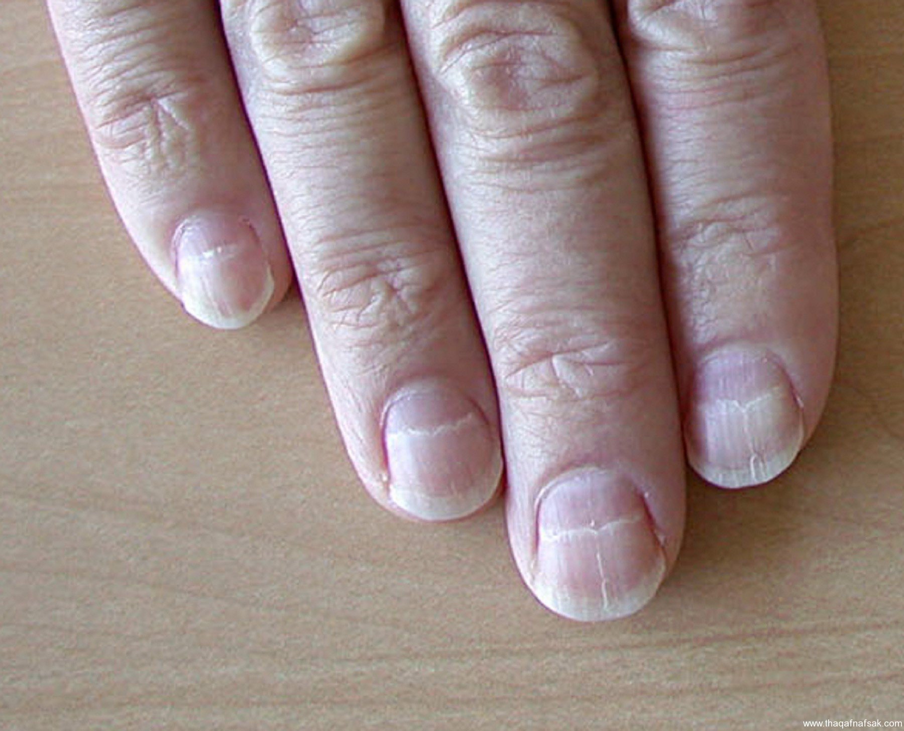 Лунулы. Полосовидная лейконихия. Белые полосы на ногтях рук.