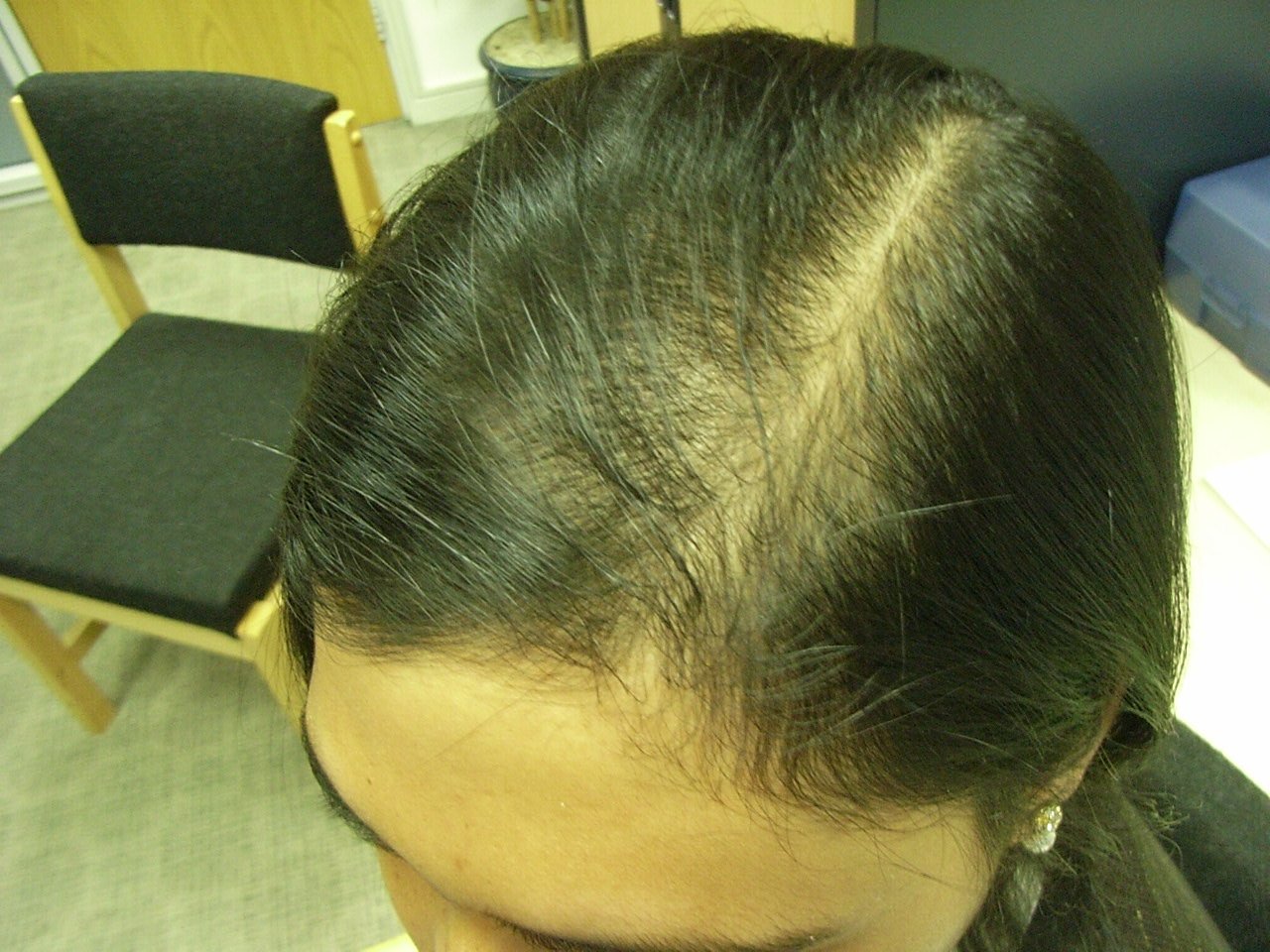 Сильно выпадают волосы отзывы. Андрогенная алопеция алопеция. Редеют волосы. Андрогенная алопеция у женщин.