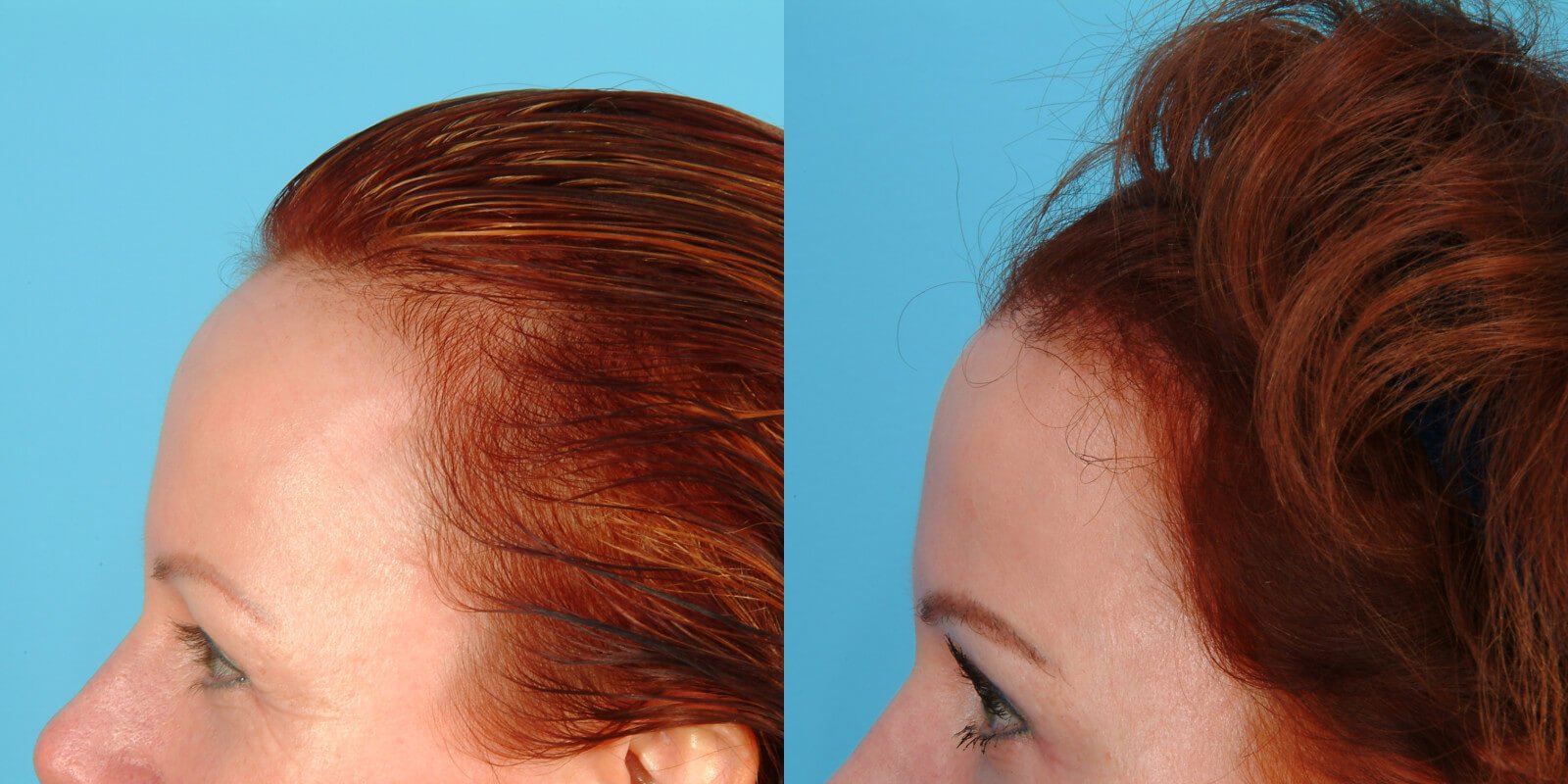 Новый лоб. Трансплантация волос у женщин. Линия роста волос. Неровная линия роста волос на лбу. Линия волос у женщин.