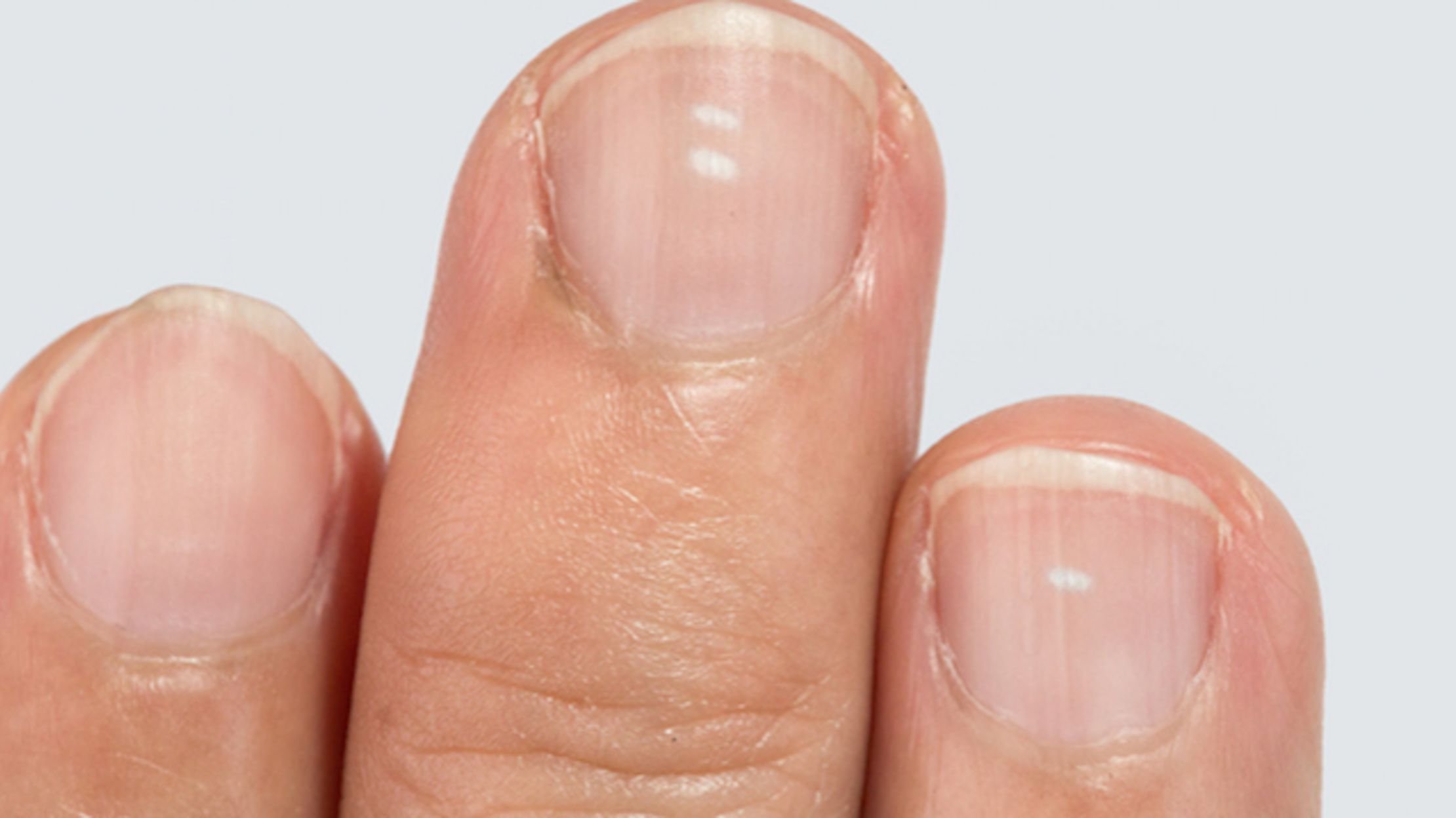 Что означают белые пятна на ногтях рук. Точечная ониходистрофия. Микотическая лейконихия. Лейконихия продольная.