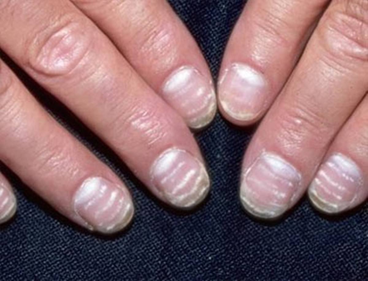 Полосы на ногтях что значит. Микотическая лейконихия. Лейконихия (белые пятнышки). Псориатическая лейконихия.