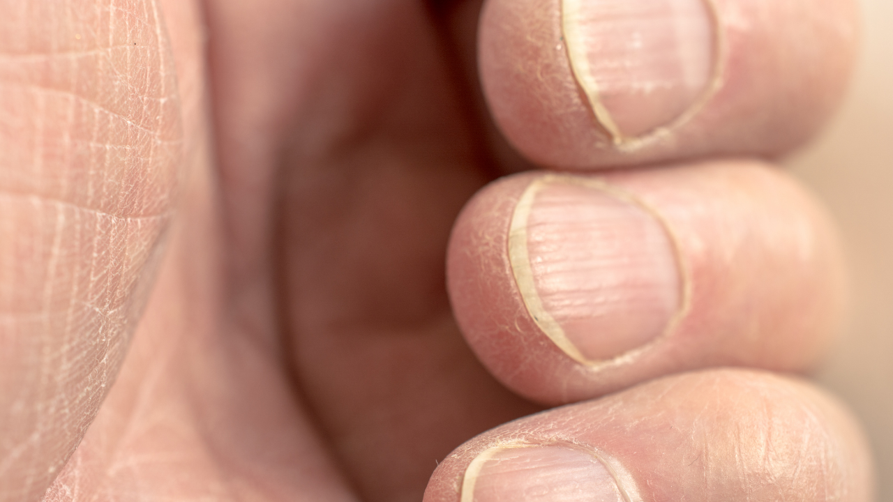Сильно слоятся ногти. Наперстковидная истыканность ногтей. Синдром наперстка на ногтях.