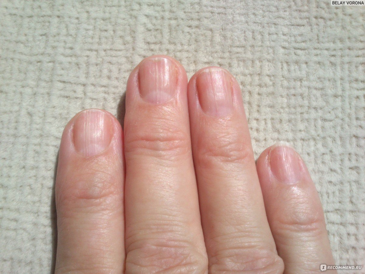 Ребристые ногти причина у мужчин. Микотическая лейконихия. Поперечные полосы на ногтях. Неровности на ногтях рук.