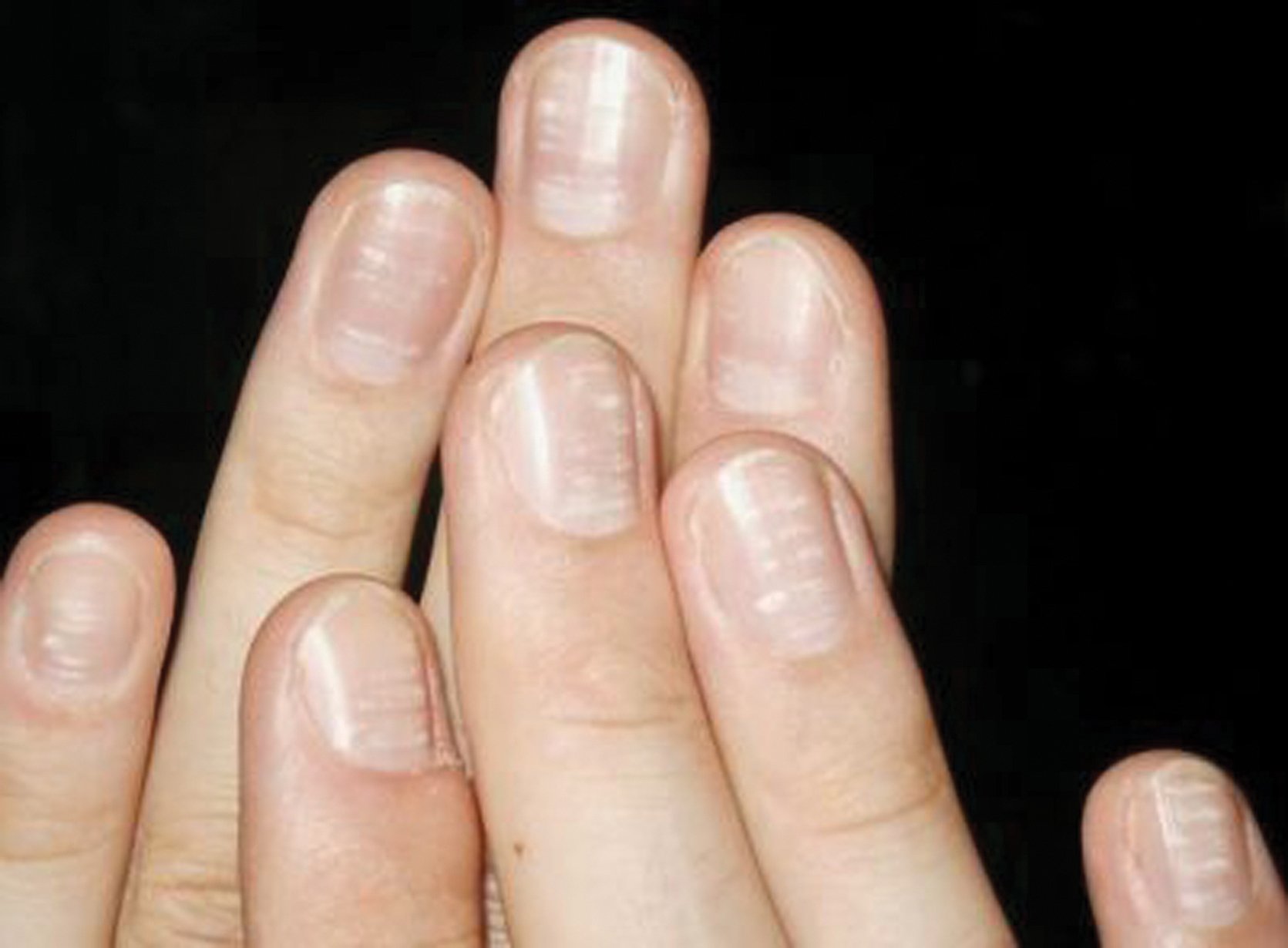 Ребристые ногти причина у мужчин. Лейконихия (белые пятнышки).