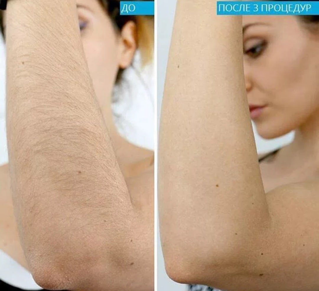 удаление волос с груди у женщин фото 64