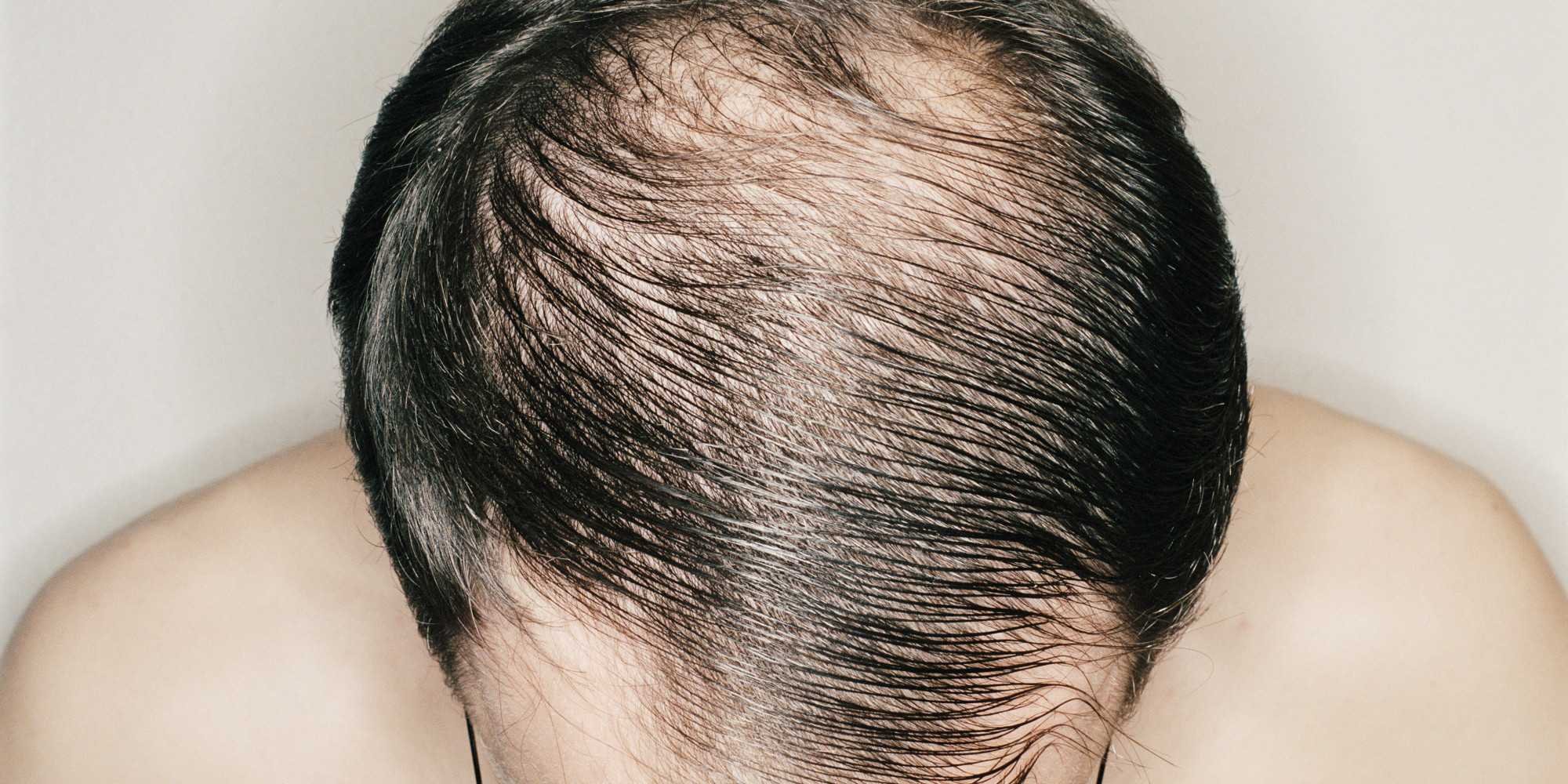 Причины выпадения волос у подростка. Гнёздная (очаговая алопеция). Экозависимая алопеция. Андрогенетическая алопеция. Андрогензависимая алопеция.