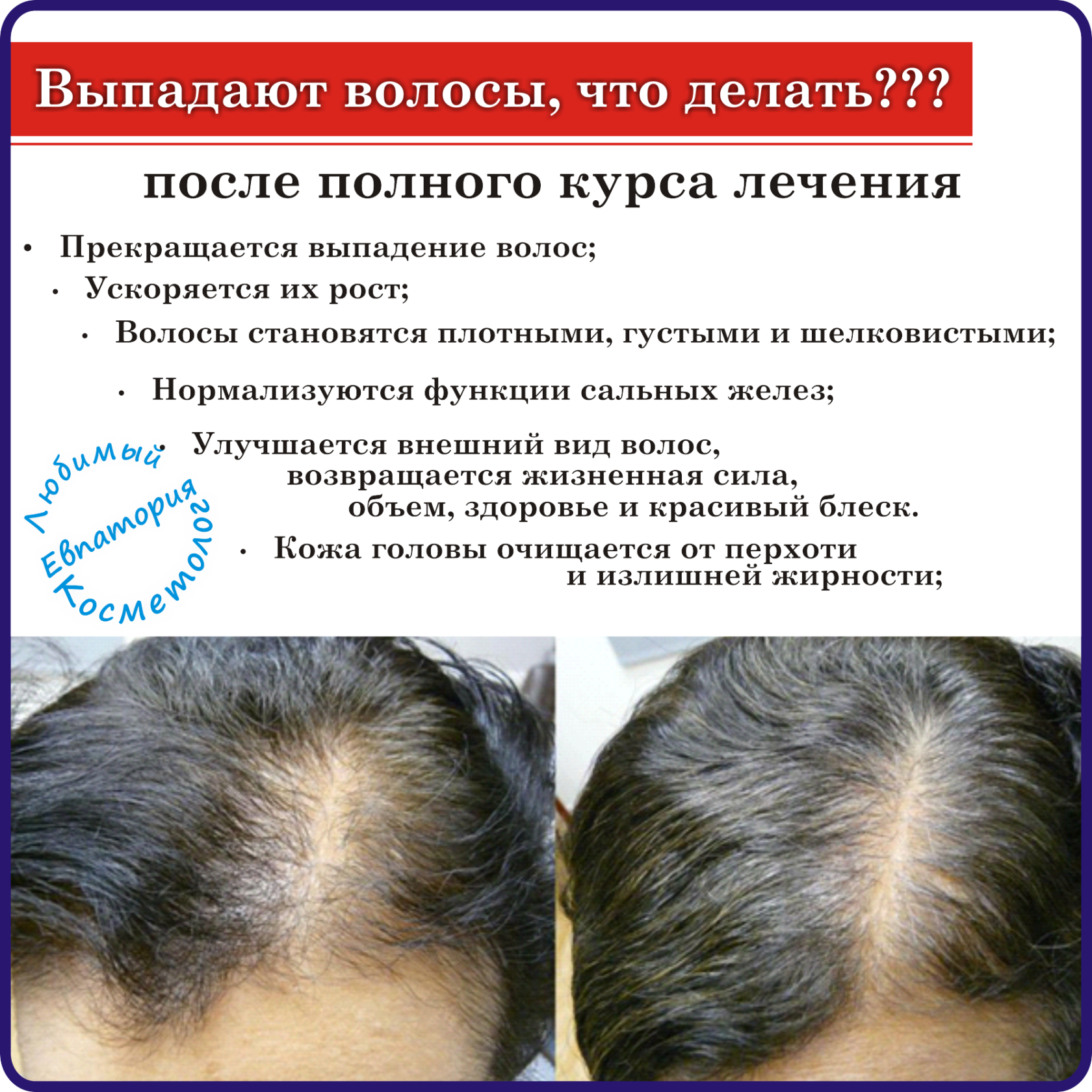 Причины сильного выпадения волос. Рекомендация при выпадении волос. Выпадение волос у женщин.