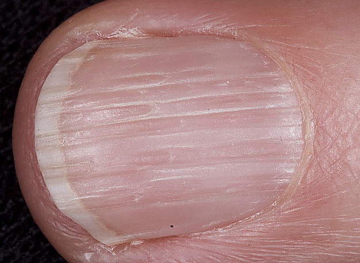 Почему ногти становятся тонкими. Поперечные борозды бо-Рейли. Ониходистрофия - онихолизис.. Онихорексис и онихошизис. Ониходистрофия (дистрофия ногтей).