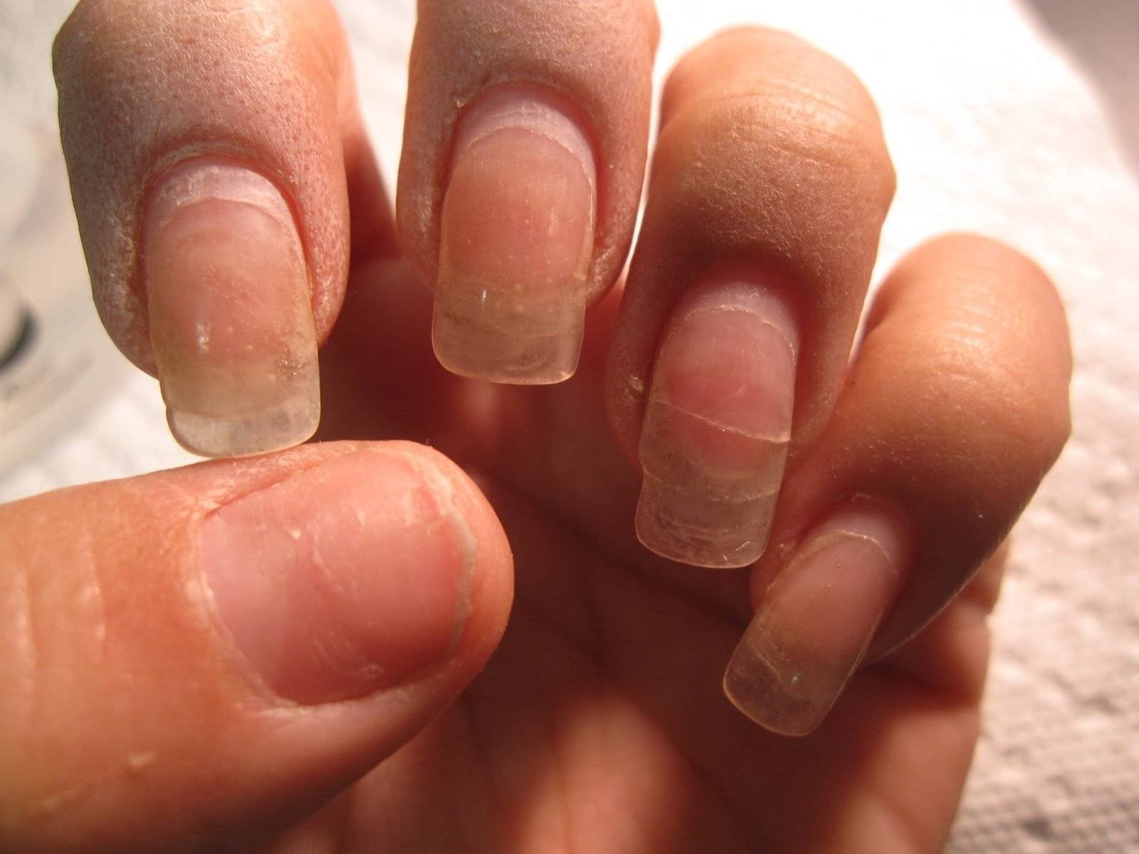 Что делать если ногти мягкие. Ногти после наращивания. Ногти после наращивание ногтей. Последствия наращивания ногтей.