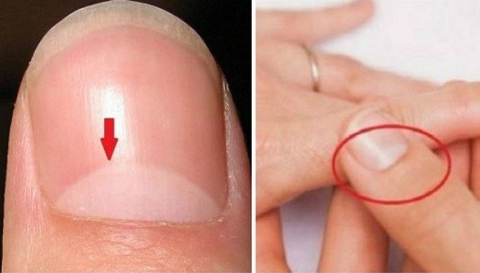 Белый полукруг на ногтях. Белый полукруг у основания ногтя что это. Белое пятно у основания ногтя.